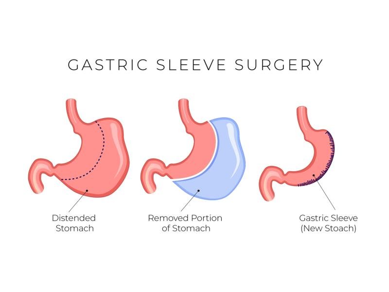 Sleeve Gastrectomy