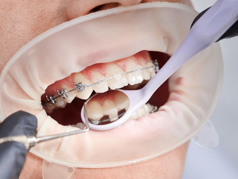 Orthodontic Treatment